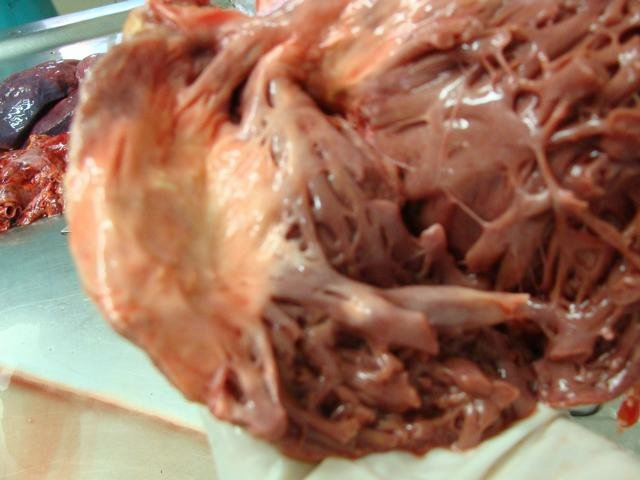 calcified cardiac wall